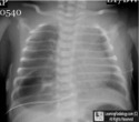 Congenital Cystic adenomatoid malformation  CCAM  